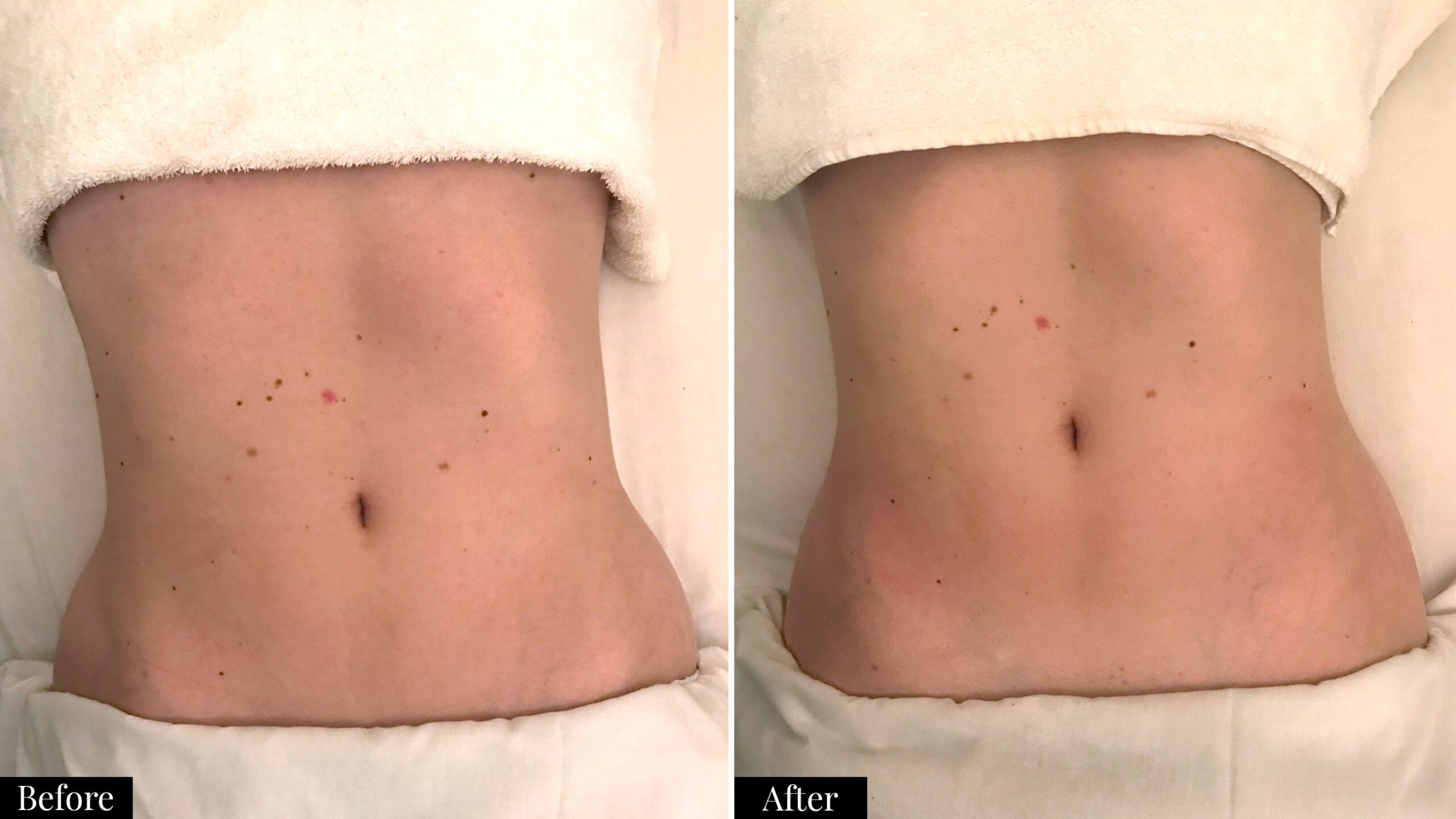before and after Camila Perez lymphatic drainage massage