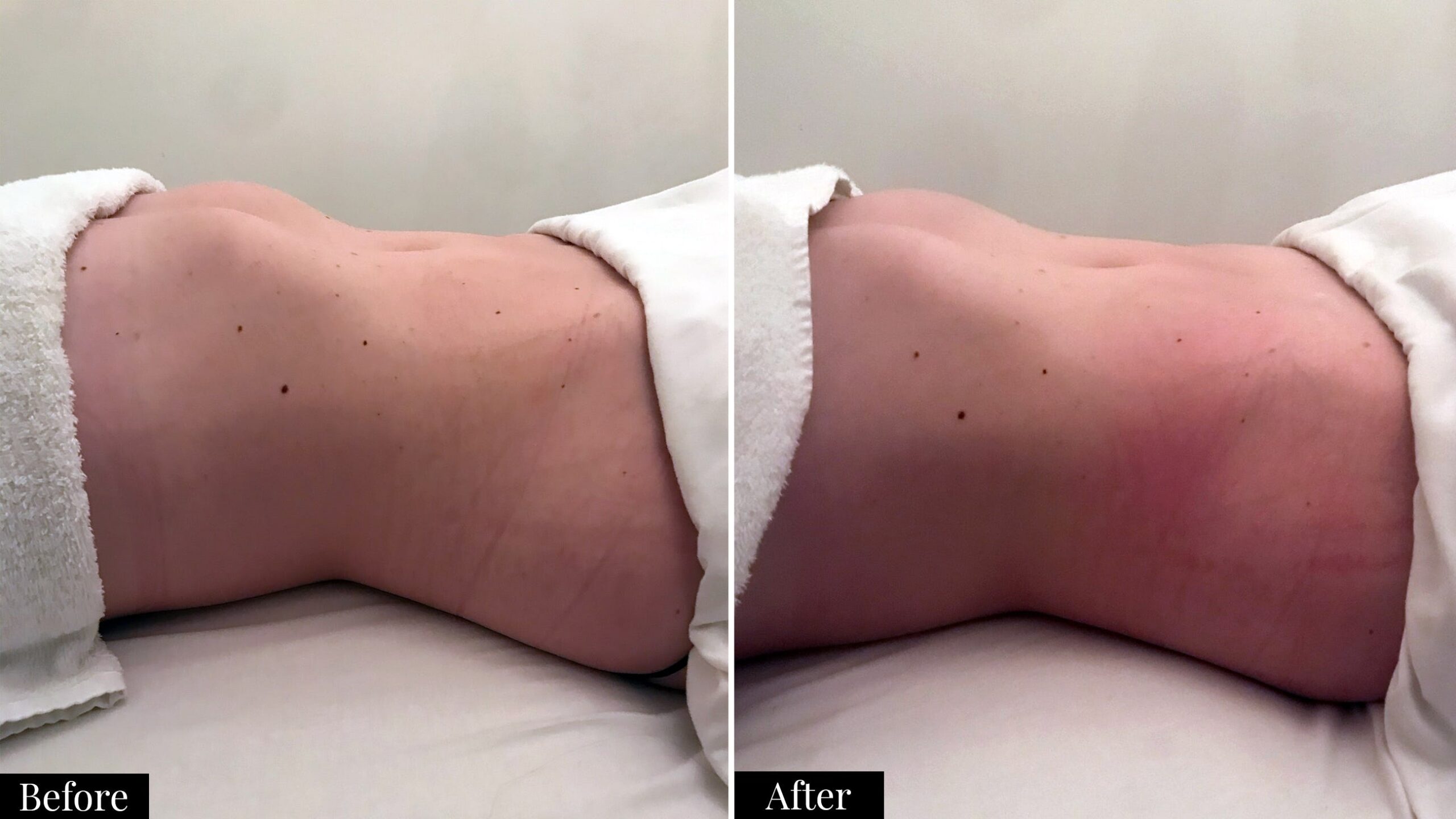 before and after camila perez lymphatic drainage massage-2