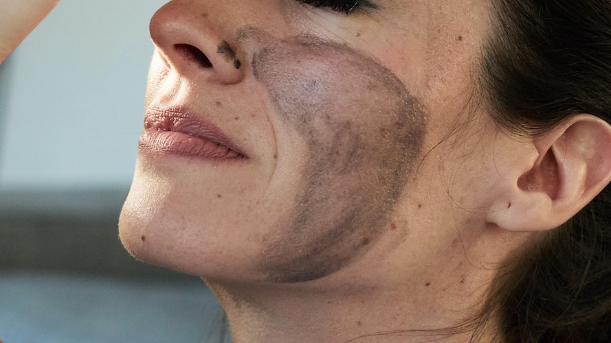 TreatMEnt of the Week: HeBe Skin Health’s Black Out Laser Peel